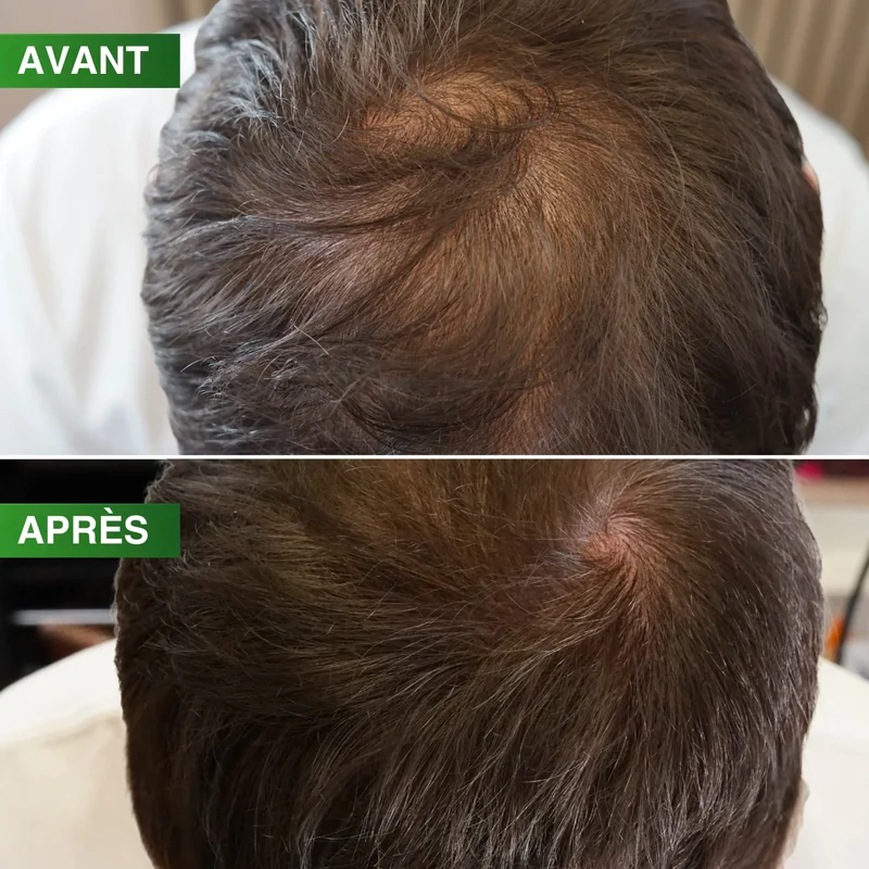 Dermaroller Densité Pro BBHAIR Generik